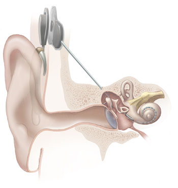 Funktionsweise eines Cochlea-Implantats